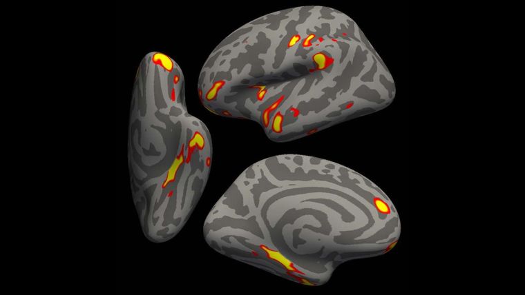 Infected vs non-infected grey matter thickness (a brain scan image)
